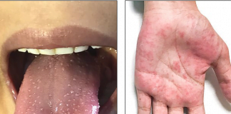 Mjekët e shqetësuar, fëmijët me koronavirus po shfaqin një sindromë të re inflamatore