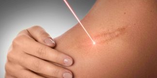 Përfitimet e lazerit në dermatologji