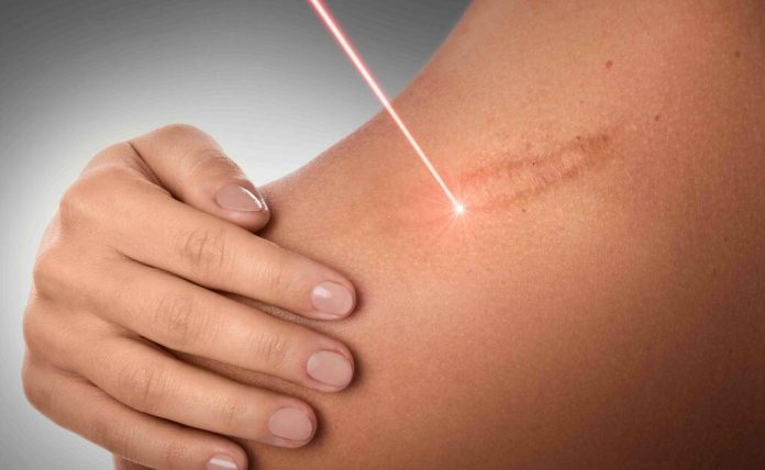 Laser scar removal treatment