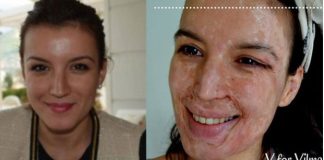 E mbani mend Vilmën nga Vlora që e shpërfytyruan me acid në një call-center? Ajo nuk u dorëzua kurrë dhe sot i ka habitur të gjithë