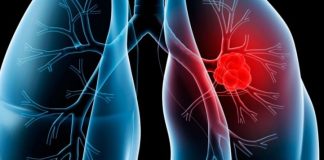 Në dispozicion një ilaç i ri i kundër kancerit të mushkërive