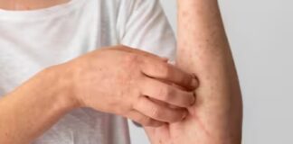 Sindroma Alpha-Gal (AGS) ose alergjia e mishit të kuq: Shkaqet dhe simptomat