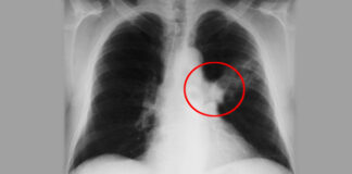 Mjeku tregon dallimin kryesor mes ftohjes së zakonshme dhe inflamacionit të rëndë