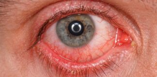 Vapa e verës mund t’ju dëmtojë sytë/ Masat paraprake që duhet të merrni