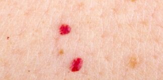 A duhet të shqetësohemi për pikat e kuqe në lëkurë?