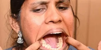 26-vjeçarja nga India me 38 dhëmbë hyn në Librin e Rekordeve Guinness!