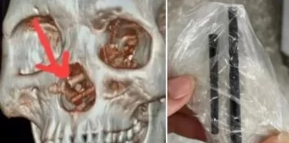 Shokohen doktorët, 35-vjeçarit i gjejnë shkopinj të thyer në tru! I kishin hyrë nga hunda