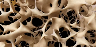 Osteoporoza, shtohet një tjetër faktor rreziku