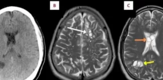 Ankohej nga dhimbja e kokës së vazhdueshme, mjekët i gjejnë vezë krimbash në trurin e tij: Kujdes nga mishi i derrit…