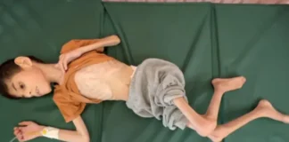 Pamje tronditëse! Fëmijët e gjymtuar nuk flasin dhe lëvizin dot, ndodhen afër vdekjes! Shkak kontaminimi i ujit dhe kequshqyerja në Gaza