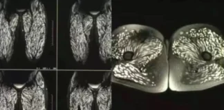 Hëngri për 10 vite mish derri të papërpunuar, mjekët bëjnë zbulimin shokues tek trupi i 23-vjeçares