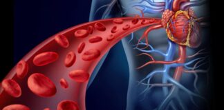 FOKUS – Cila është lidhja mes kolesterolit, triglicerideve dhe demencës?