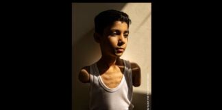 FOKUS – Portreti i një fëmije palestinez të amputuar fiton ”World Press Photo 2025”