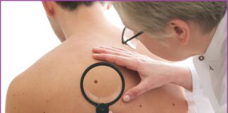 IA përshpejton diagnostikimin e kancerit të lëkurës në pjesë të largëta të botës