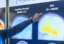 Një tampon nazal mund të identifikojë Alzheimerin në fazat e para