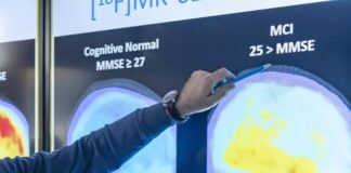 Një tampon nazal mund të identifikojë Alzheimerin në fazat e para