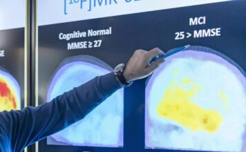 Një tampon nazal mund të identifikojë Alzheimerin në fazat e para