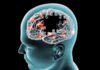 Pse terapia nuk funksionon njësoj për të gjithë pacientët me parkinson?